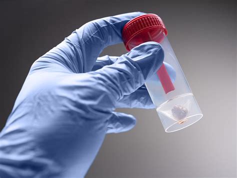 Stool test: Procedure, results, and more .